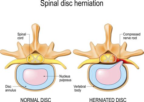 Cervical Radiculopathy and Herniated Disc | Antonio Webb - Neck, Back ...