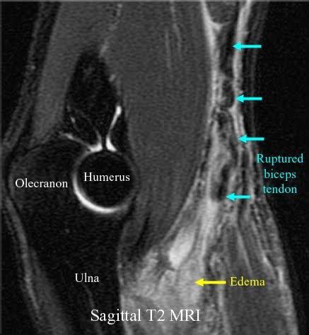 RadiologySpirit: Elbow: Biceps Tendon Rupture on MRI Scan