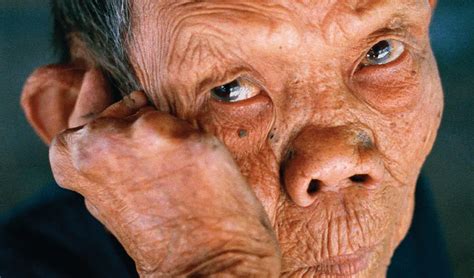 Leprosy (Hansen’s Disease): Causes, Symptoms and Treatments | Healthtian