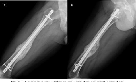 Figure 1 from Accelerated callus formation and fracture union in ...