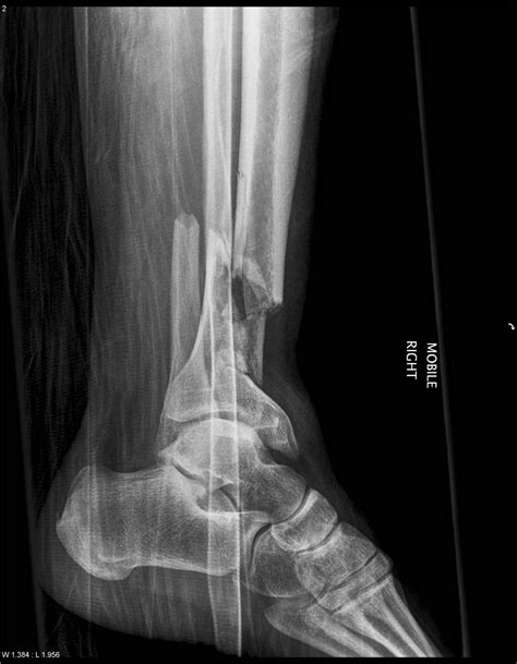 Tibial Plafond Fractures - Trauma - Orthobullets