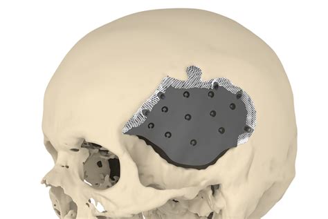 A novel implant enhances skull surgery outcomes - Research Outreach