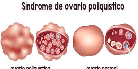 Síndrome de ovario poliquístico: diagnóstico y tratamiento - Dra. Marta ...