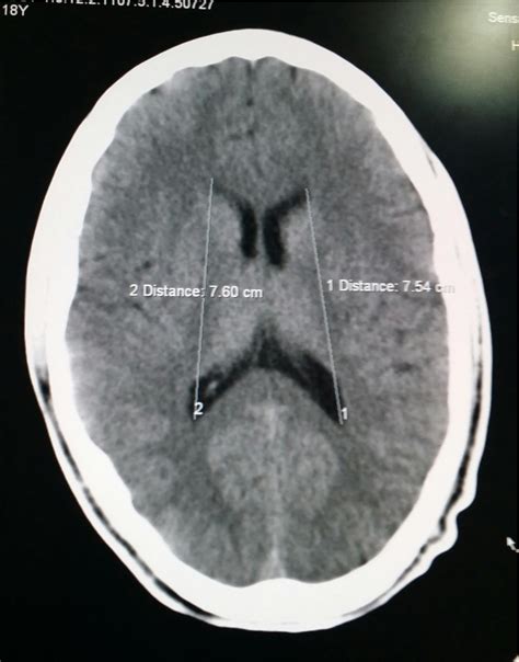 Normal Brain Mri Ventricles