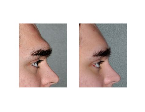 brow bone reduction Archives