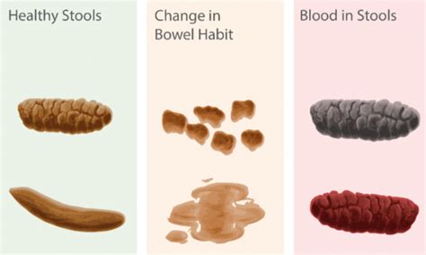 Colon Cancer Stool Color Chart