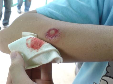 Paintball Bruises