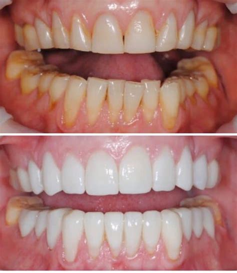 Veneers Before and After Results