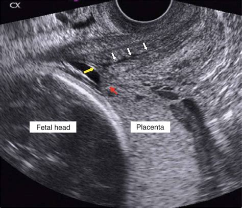 Complete Placenta Previa