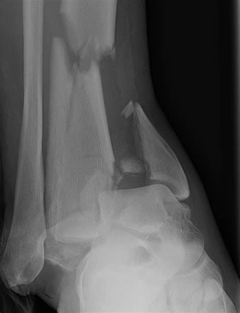 Tibial Plafond / Pilon | The Bone School