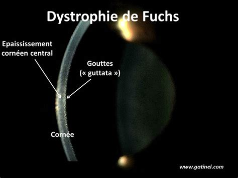 Dystrophie Endothéliale De Fuchs; Dégénérescence cornéenne endo ...