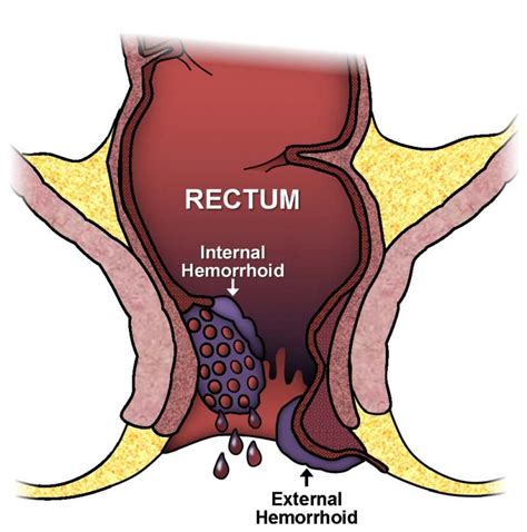 Hemorrhoids: Causes, Symptoms & Management | Dubai, UAE | Westminster ...