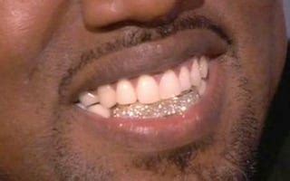 Dentist On Kanye's Diamond Teeth: "Good Luck With Oral Hygiene"