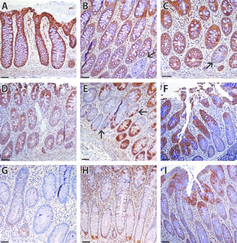 Representative cytochrome C oxidase (COX) staining patterns. A–C ...