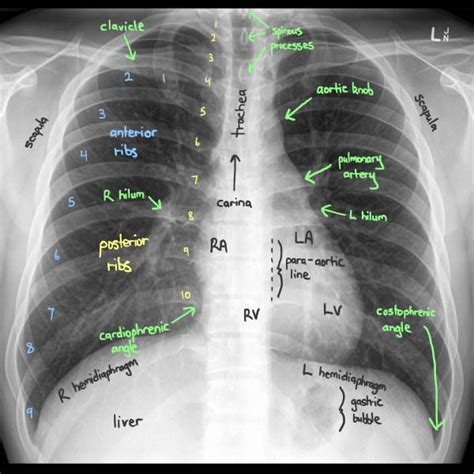 Anatomy Of Chest X Ray - X Thorax Startradiology - It first appears too ...