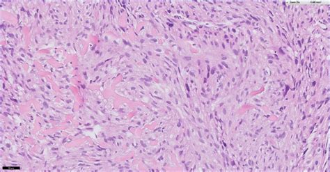 Osteosarcoma Histology