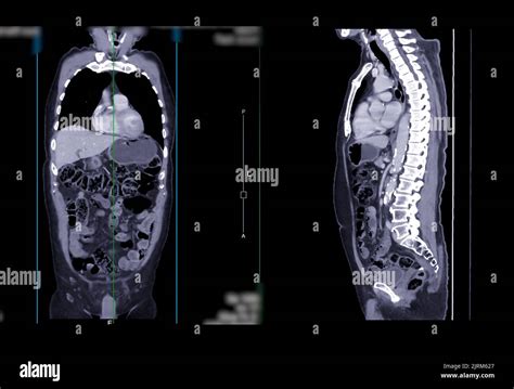 Normal Ct Scan Abdomen