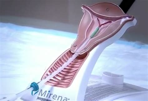 mirena-iud-scan - Consumer Safety Watch