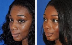 African American Rhinoplasty Beverly Hills - African American Nose Job LA