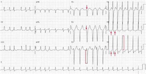 ECG Case 122: Atrial Fibrillation with Rapid Ventricular Response ...