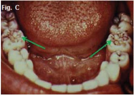 Moon Molars—What Causes It? | News | Dentagama