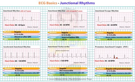 Junctional Rhythm Cheat Sheet