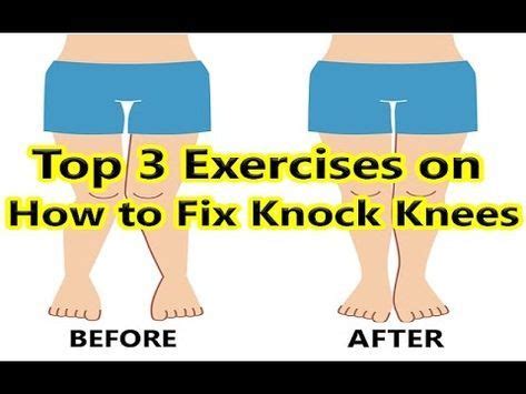 Top 3 Exercises on How to Fix Knock Knees | Knock knees, Knee exercises ...