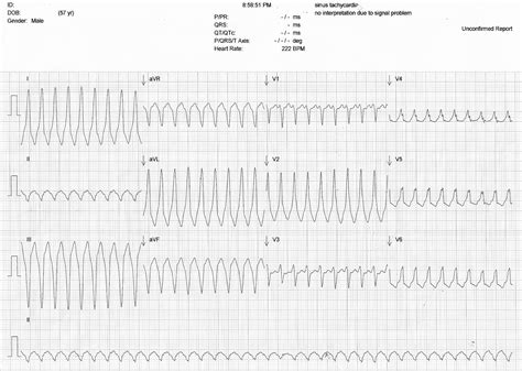 Wide Complex Tachycardia in a Patient with WPW | ECG Guru - Instructor ...