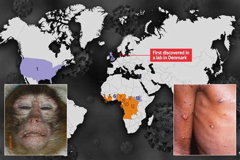 Monkeypox: Inside dreaded outbreaks as virus first found in brain test ...