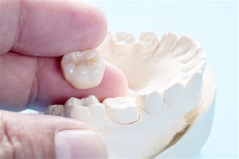 What Are the Different Types of Dental Crowns? | Montgomery, AL