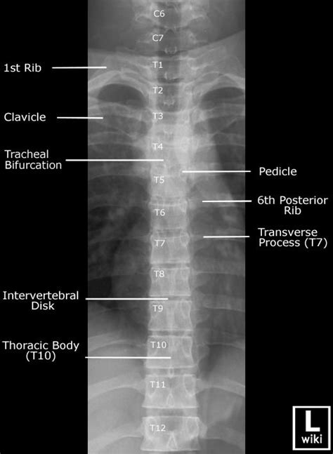 Thoracolumbar spine x-rays