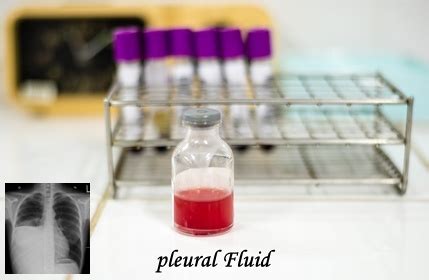 Pleural Fluid Analysis - Pathology Made Simple