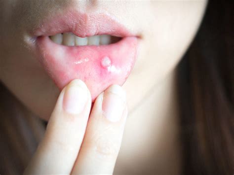 Tongue Blisters: 5 Incredible Natural Remedies To Heal Soreness ...