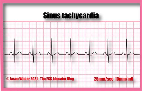 Supraventricular Tachycardia Rhythm Strip