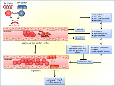 Sickle Cell Disease Diagram