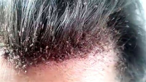 Head lice infestation - Symptoms, causes and risk factors