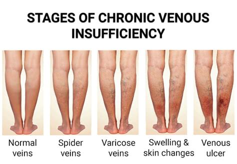 Venous Insufficiency - Vein & Endovascular Medical Care