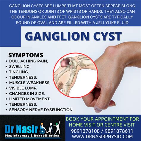 Ganglion Cyst Causes Management Of Painful Ganglion Cysts | NBKomputer