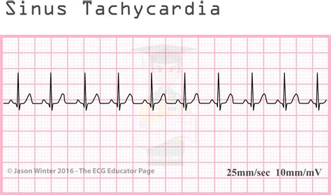 ECG Educator Blog : Sinoatrial Node rhythms