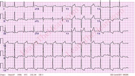 Left Ventricular Hypertrophy With Strain Pattern (Example 3 ...