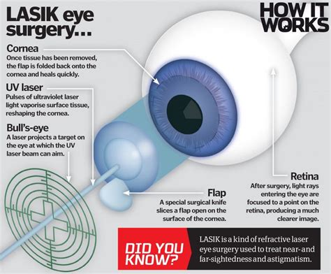 eye surgery laser - Google Search | Laser eye surgery, Eye surgery, Lasik