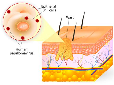 Plane Warts (verruca plana) Removal Service | CoLaz Aesthetics Clinic