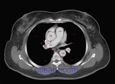 Learn CT Scan: Anatomy CT Axial Chest