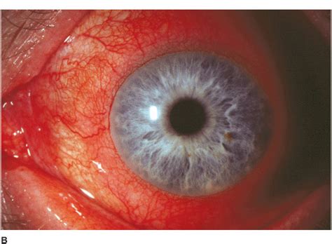 Anterior Sclera and Iris | Ento Key