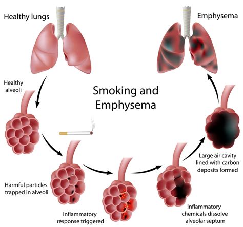 Solved The leading cause of emphysema, a type of chronic | Chegg.com