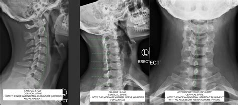 Cervical Spine Ap X Ray