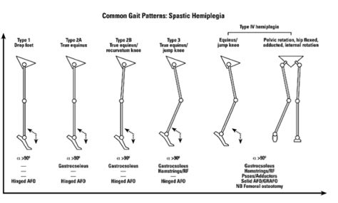 Classification Of Gait Patterns In Cerebral Palsy Physiopedia 29036 ...