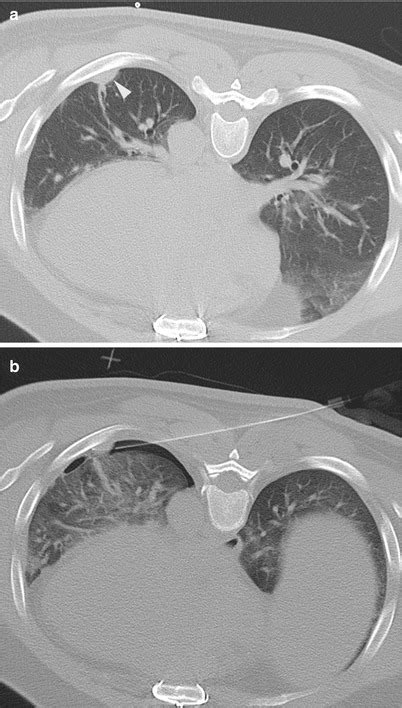 Pleural Biopsy | Radiology Key