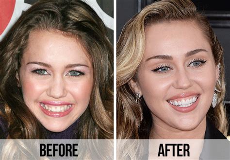 Miley Cyrus Crooked Teeth