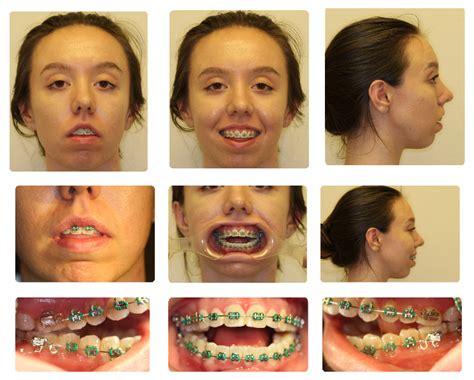 TMJ Replacement Surgery Naperville, Joliet, Yorkville IL